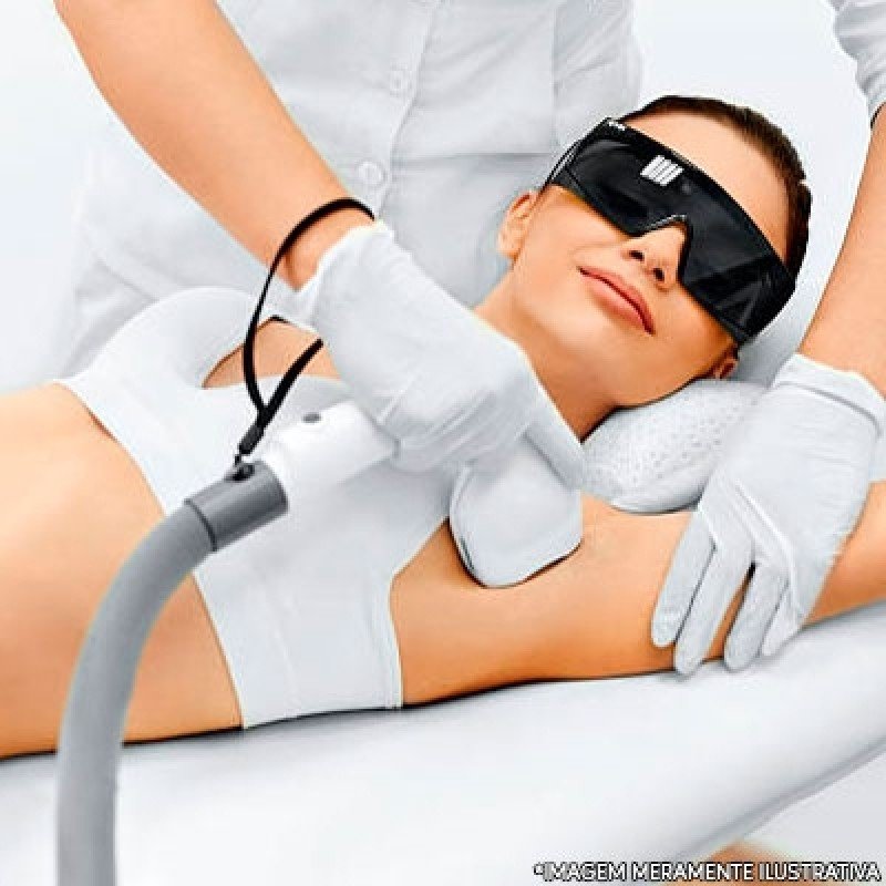 servico-de-depilacao-a-laser-axila